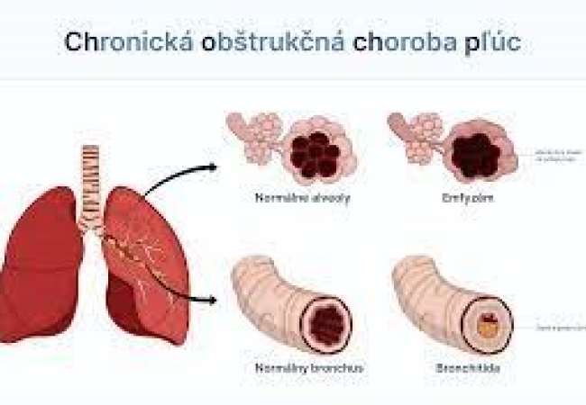 Chronická obštrukčná choroba pľúc (CHOCHOP)