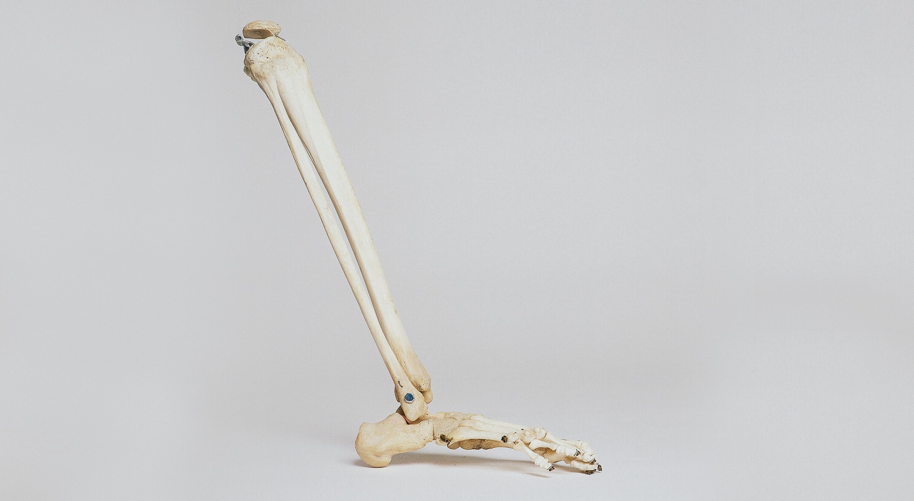 Osteoporóza - tichý zlodej kostí